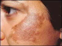 د مخ داغونه