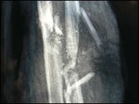 Đoạn phim X-quang cánh tay bị thương của Hưng