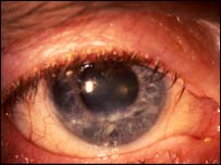 د سترګو غير مکروبي التهاب