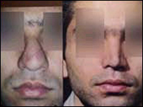 يک مرد قبل و بعد از عمل جراحی بینی