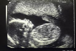 Baby Scans