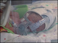 Uma das quíntuplas em incubadora