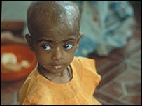 Yetersiz beslenmiş bir çocuk