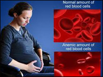 کم خونی در بارداری 