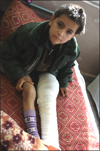  د هډوکي کسر