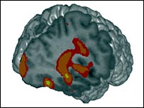 Ressonância do cérebro de um pedófilo