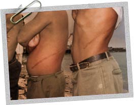 Kidneys are often sold to pay off debts