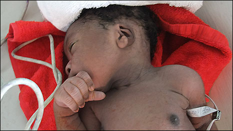 A baby in the Isaie Jeanty Hospital in Port au Prince, Haiti