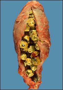 سنگ ها در کيسه صفرا