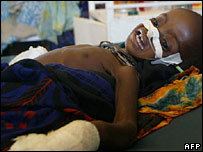 Somali'de yetersiz beslenen bir çocuk