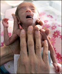 بې وخته پيدا شوی ماشوم