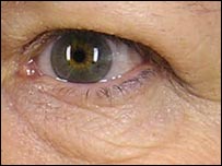 بھارتی باشندے کی آنکھ خطرے میں 