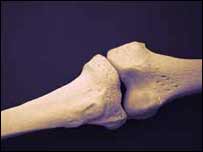 کمزور ہڈیاں