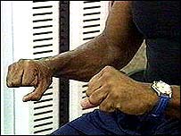 Pacient s Parkinsonovou nemocí