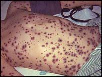 بيماری آب چيچک