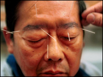  آکوپنکچراور برقی لہروں کا استعمال 