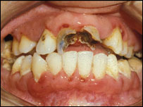 دغاښونوتورېدل