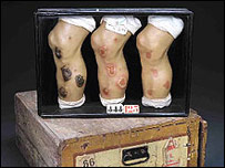 梅毒溃疡治疗蜡制模型（1910年）