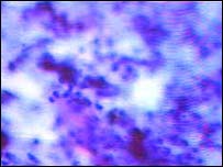 سرطان سے متاثرہ خلیے 