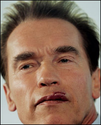 आर्नल्ड की होंठ पर टाँके