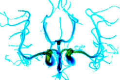 brain blood flow patterns modelled using grid computing