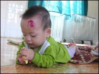 يک کودک ويتنامی مبتلا به ايدز