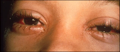 د سترګو مکروبي التهاب