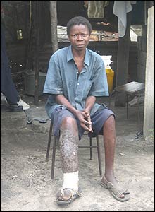 man with aids and elephantitis