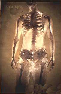 شکستگی استخوان