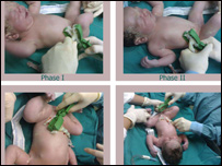  ناف بريدن نوزاد