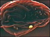 بيمار مبتلا به پارکينسون