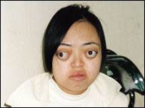 Cerca de 150 mil crianças vietnamitas teriam sofrido efeitos do agente laranja