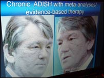 Фото 2 з доповіді професора: Віктор Ющенко після отруєння