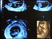 Imagem de feto capturada por meio de ultra-som