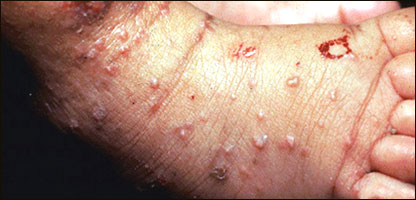 ګرګ ( سکبيس )