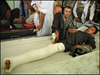 د کندوز په هوايي بريد کې ټپي شوی ماشوم