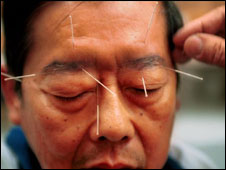 Acupuncture
