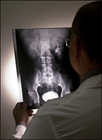 کسر استخوان